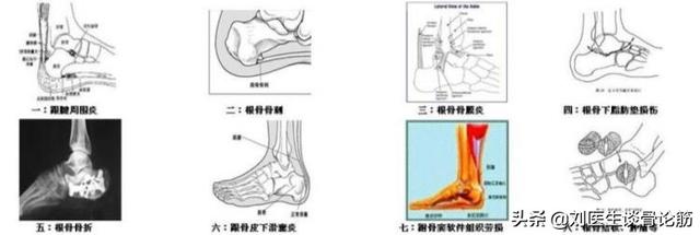 足跟痛是怎么引起的，足跟痛是怎么引起的足跟痛怎么办呢？