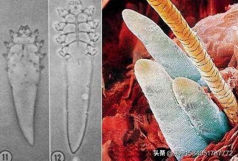 毛囊虫的原因是什么:头上长螨虫是什么原因？应该注意哪些信号？