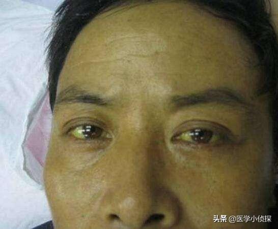 头条问答 - 肝不好的人,身体会有4个症状,具体是什么?(12个回答)