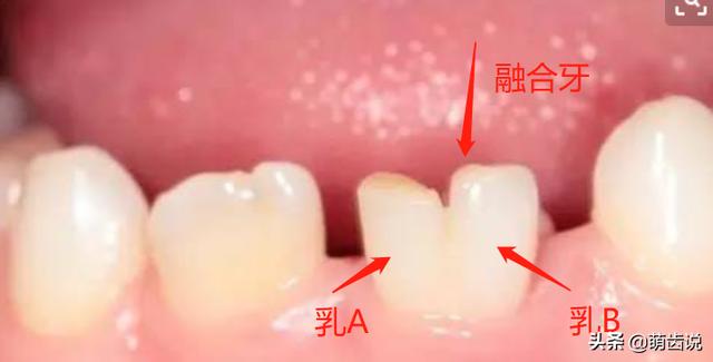 换多少颗牙齿:儿童一共要换多少颗牙齿？