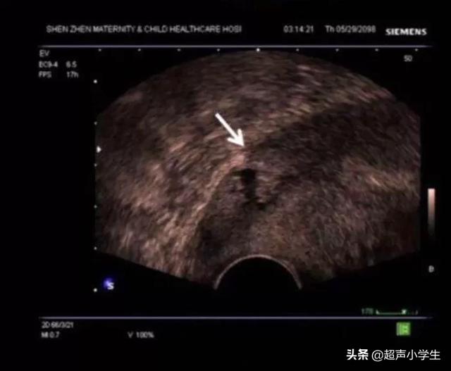头条问答 怀孕13周 胎盘下缘完全覆盖宫颈内口 这是二胎 一胎剖腹产 很危险吗 6个回答