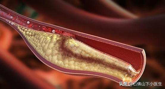 低密度脂蛋白高怎麼調理