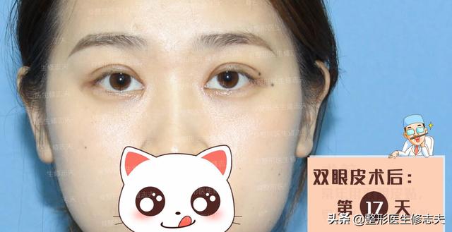 古巨基割双眼皮:长期贴双眼皮贴最后都会走上割双眼皮的路吗