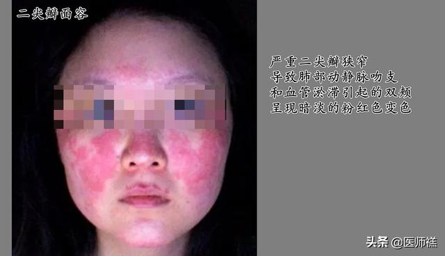 心肌缺血的早期症状,心脏病的早期症状是怎样的？