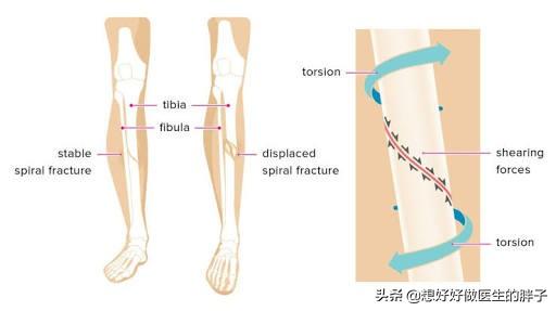 胫腓骨骨折保守治疗一个月:右胫腓骨骨折多少天能下地负重行走？