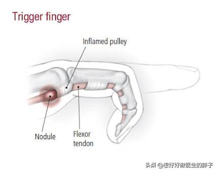 手部增生性关节炎怎么治:指关节胀痛僵硬暗示什么疾病？ 手关节增生性关节炎怎么治疗