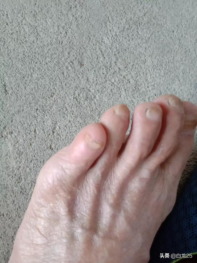 头条问答 - 有没有小拇脚趾头不劈叉的人?汉族都是吗?(5个回答)