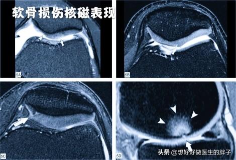 膝盖软骨磨损微创手术费用:膝关节前交叉韧带的损伤与治疗？