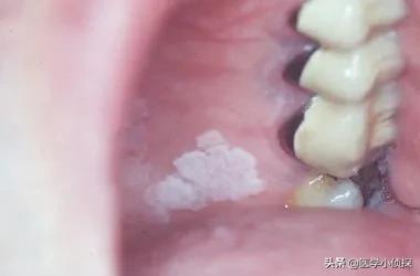 7莱姆病症状太容易被忽视:哪些症状连续出现是癌症的表现？