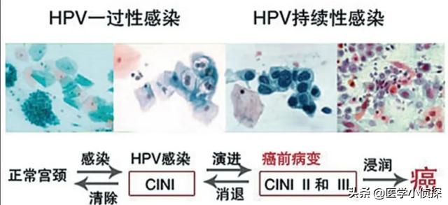 疣状表皮发育不良:女子打过hpv疫苗，6年后却查出宫颈癌，疫苗不管用吗，为何？