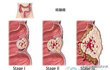 近日,省腫瘤醫院來了一位28歲的結腸癌患者小張,已經是中晚期了.