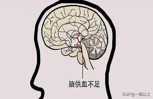 改善脑供血不足的药，脑供血不足做什么检查可以查出来