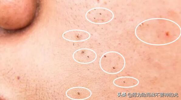 毛孔芝麻:毛孔里反复挤出来的“小米粒”，到底是什么东西？