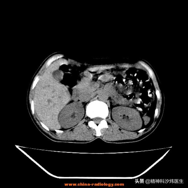 胰腺炎的症状及治疗:胰腺炎的症状及治疗吃什么药好 胰腺炎与工作强度和环境有关系吗？