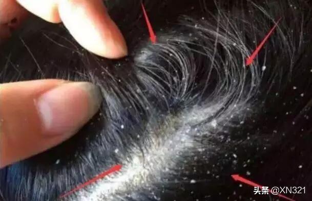 头条问答 - 从头皮上抠出软糯糯的白泥,真的是螨虫拉出来的吗?