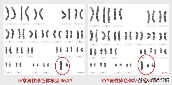 性染色体异常(如xxy型,xyy型)对个人性格的影响是什么?