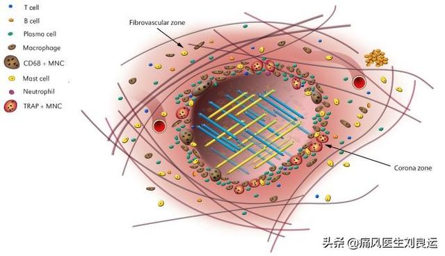 黄精蝮蛇丸:什么食物能溶解尿酸结晶？