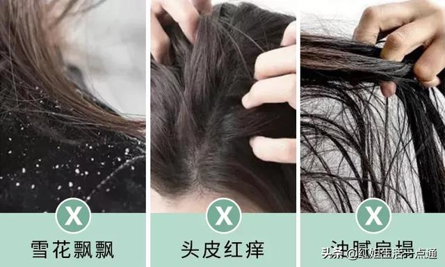 多油、头皮屑多、头皮痒,有哪些洗发水可以推荐？