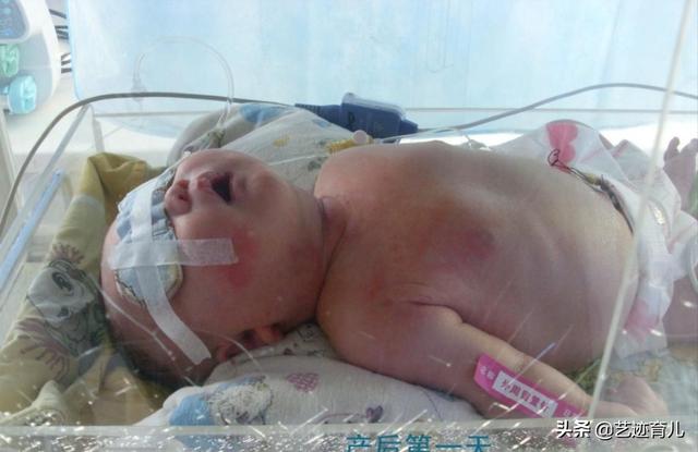 肩难产:肩难产的处理流程 国内最大的婴儿出生体重是多少？