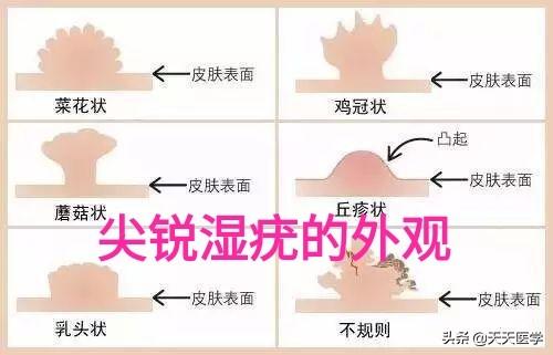 尖锐湿疣的危害(湿锐尖疣多长时间潜伏期)