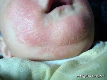 头条问答 婴儿湿疹严重要把母乳停掉换水解奶粉吗 24个回答