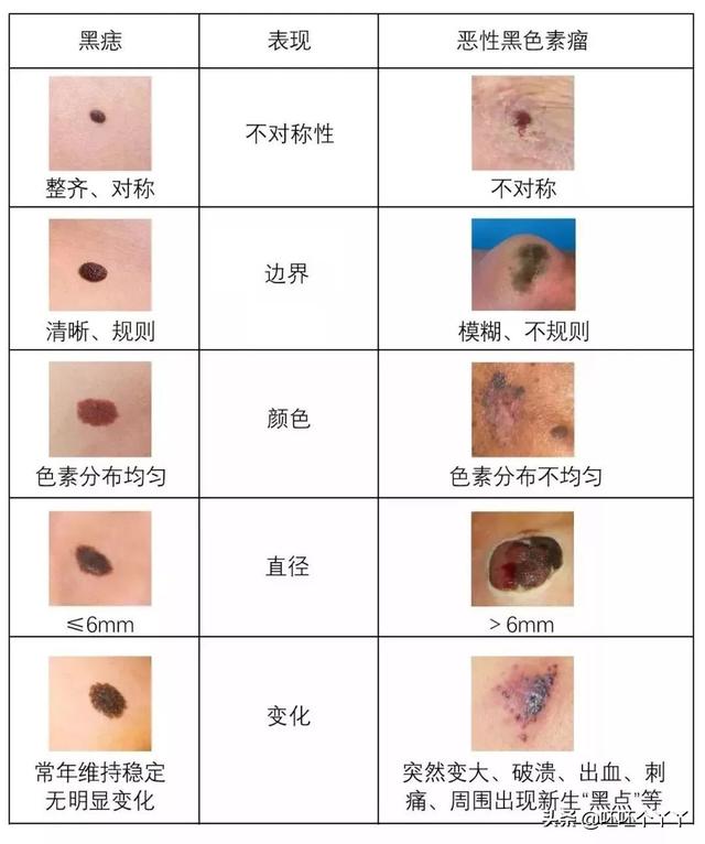 头皮黑色素瘤早期症状图片:头皮黑色素瘤早期症状图片大全 黑色素瘤一般潜伏期多久？有何症状？