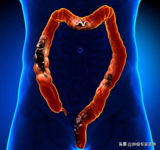 头条问答 - 结直肠癌发病初期都有什么症状,长期便秘就会得结直肠癌吗