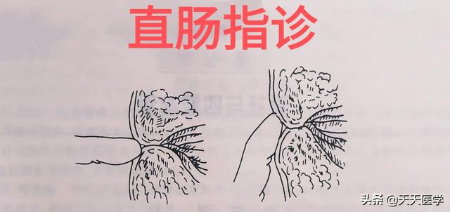 总的来说,虽然直肠指诊是发现肛管直肠及局部邻近器官疾病最直接简单