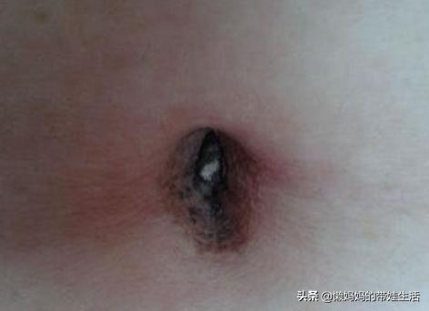 大腿肚内侧黑紫图:怀孕七个月，肚脐里面有黑泥，可以挖出来吗？