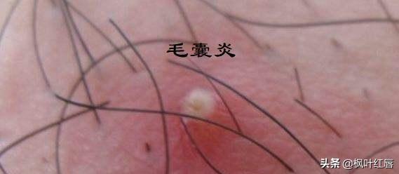 人身上被螨虫咬的图片是什么样的:被螨虫咬过的图片是什么样 大量螨虫塞满毛孔，皮肤会出现什么明显的迹象呢？