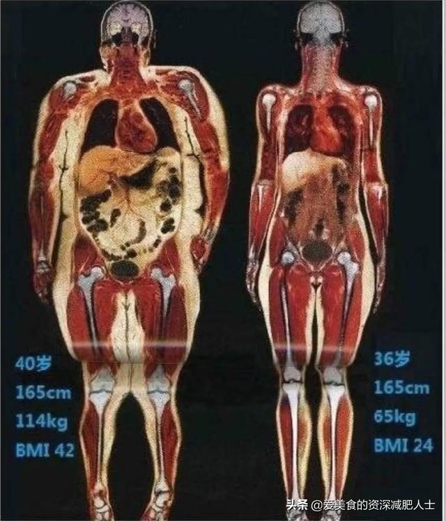 肥胖的测量标准有很多，大基数减肥最重要看哪些数据