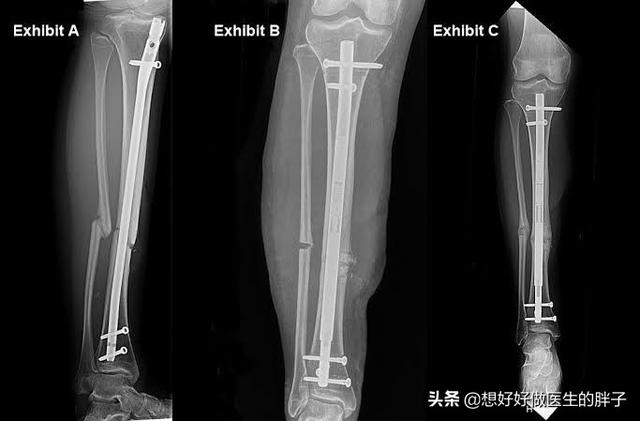 头条问答 小腿胫骨断后手术后不长骨头该怎么办 4个回答