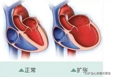 心尖肥厚性心肌病寿命:得了肥厚型心肌病的人还能活多久？