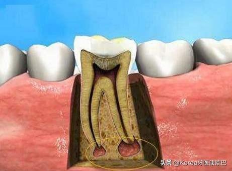 牙齿分为哪几种图一共几个图片:牙齿老是隐隐作痛?到底是犯了什么牙病？