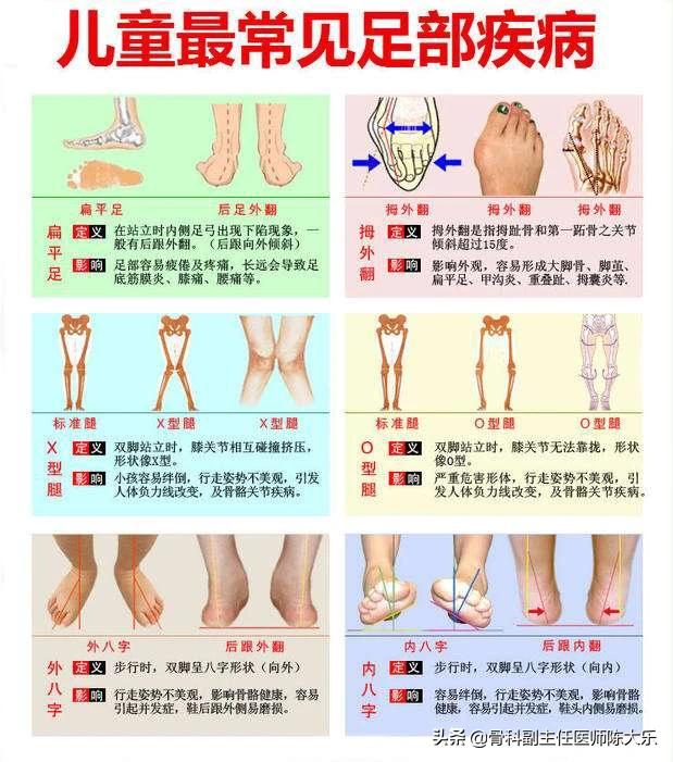 扁平足需要治疗吗图片