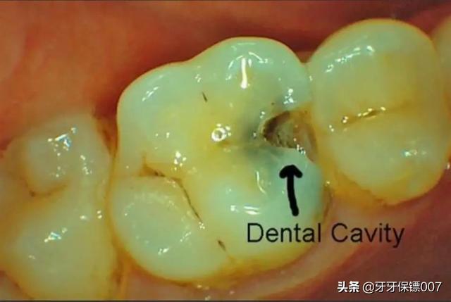 小孩换牙期间有哪些注意事项？ 3到6岁的孩子注意事项 第3张