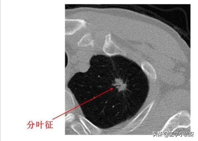 养生堂代茶饮方治疗肺部结节,肺结节喝什么水好能散结？