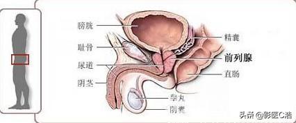 头条问答 前列腺癌有什么症状 需要注意什么 深蓝医生的回答 0赞