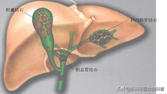 xishiroux:胆管结节怎么办谁有好办法哦？