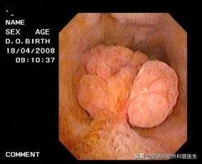 胆囊息肉可以喝红酒吗，胆囊息肉哪些食物不可以吃？