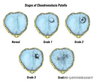 膝盖软骨磨损微创手术费用:膝关节前交叉韧带的损伤与治疗？