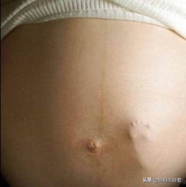 怀孕6个月，孕妇肚子突然一半硬一半软，是胎儿缺氧了吗？该怎么办？插图