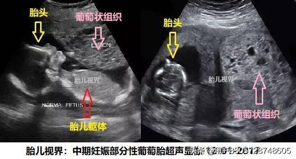 葡萄胎是怎么形成的:对于葡萄胎大家是什么看法，医生说我这是病，住了快一星期的院了