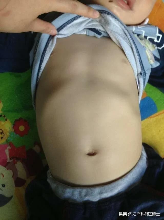 宝宝缺钙的症状和表现是什么:宝宝缺钙有哪些症状，为何天天补钙还“缺钙”？