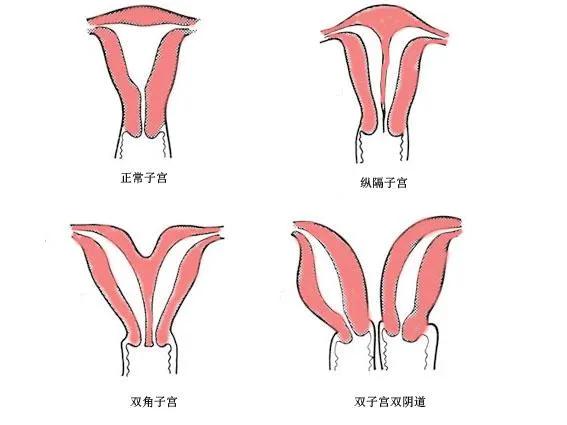 双子宫是怎么回事(有双子宫是怎么回事)