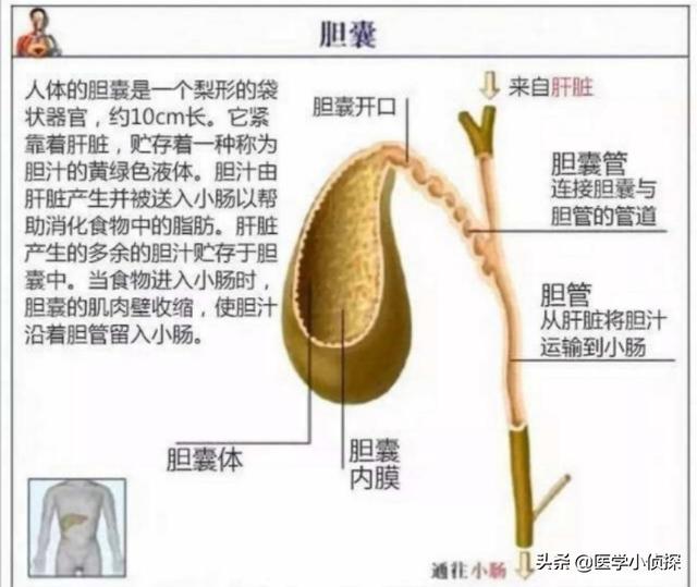 三大抗癌石,胆囊息肉、胆结石会转化为胆囊癌吗？
