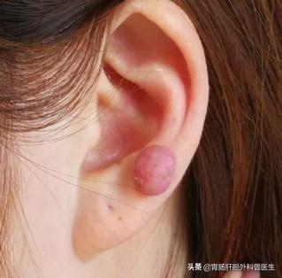 头条问答 手术后伤口愈合了 但是疤痕越来越大 是怎么回事 胃肠肝胆外科曾医生的回答 0赞