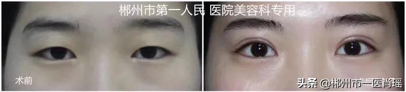 杨幂隆胸前后:整容一眼就能看出来，有什么根据？