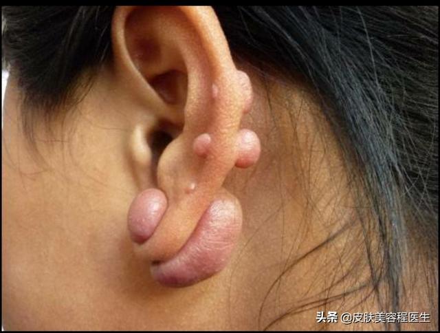 耳洞反反复复红肿发炎流脓,这期间我只带银的耳环,是不是过敏了?