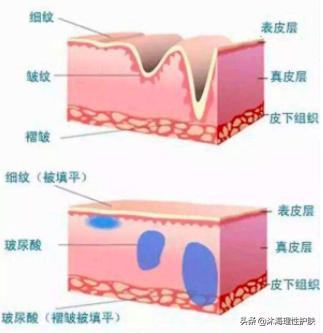 抬头纹重怎么办(天生抬头纹就很严重怎么去除)